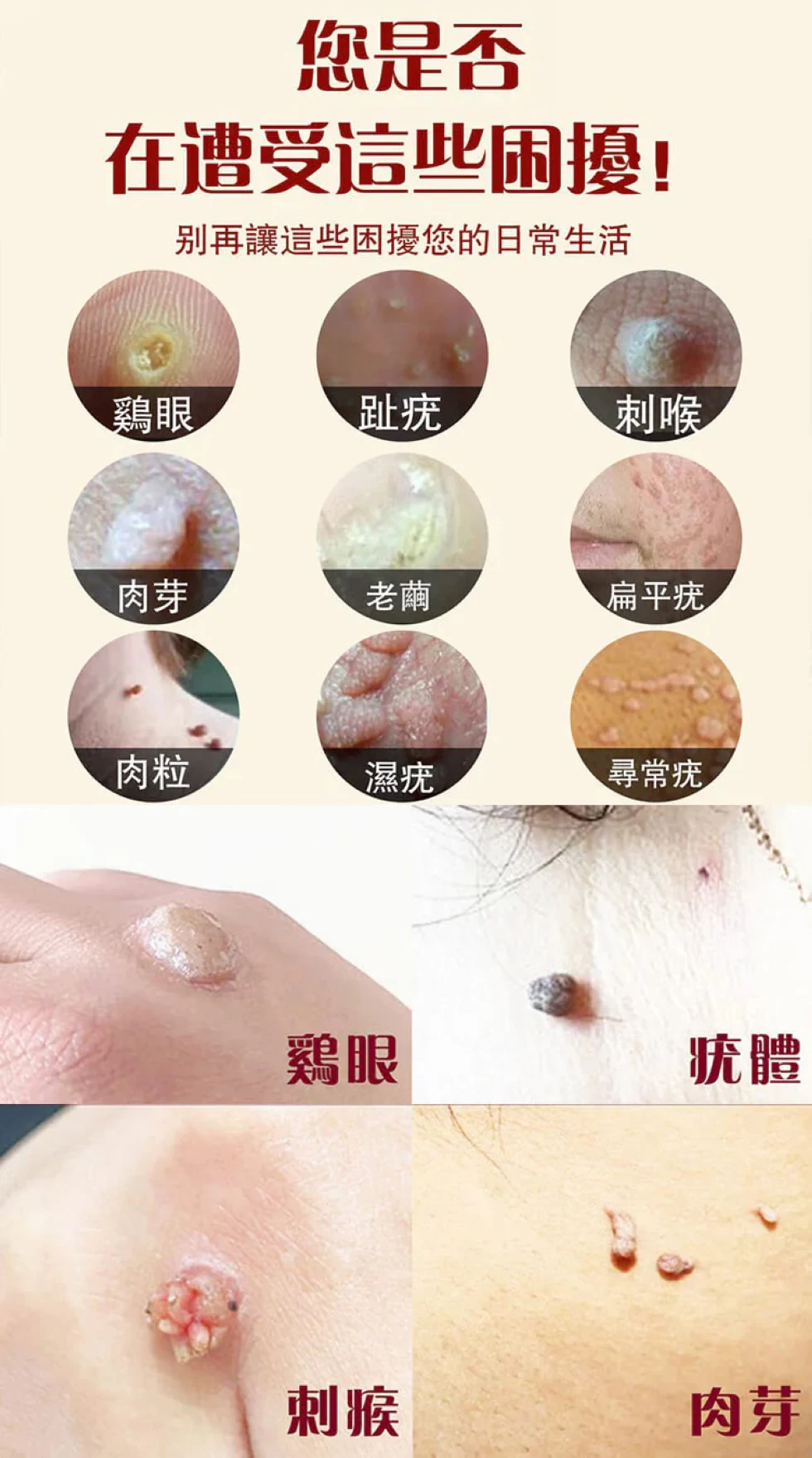 点痣祛疣皮肤净瑕护理