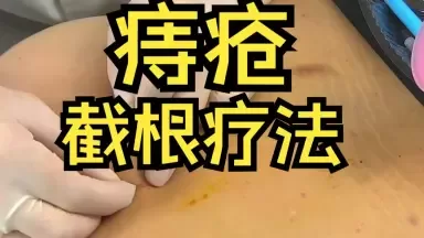 痔疮反复、坐立难安？——了解“截根疗法”的一次勇敢尝试
